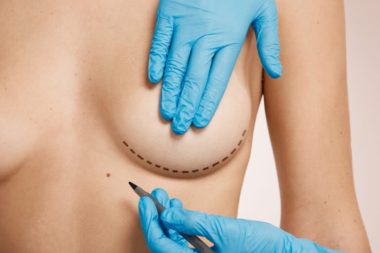 Cirujano con guantes azules trazando líneas de incisión sobre el pecho de una paciente en la planificación de una mamoplastia